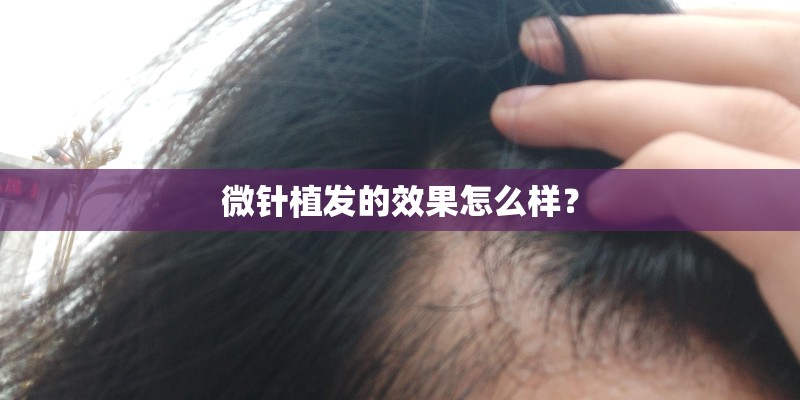 微针植发的效果怎么样？