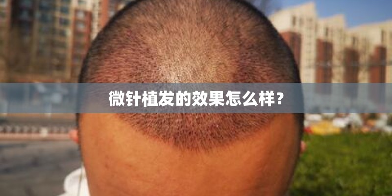 微针植发的效果怎么样？