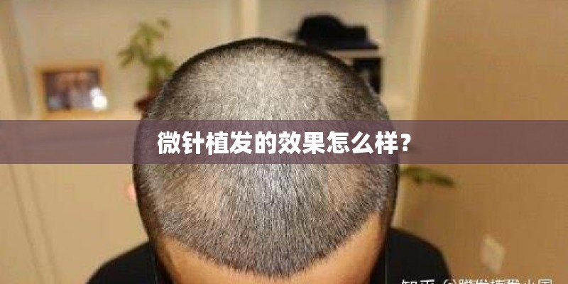 微针植发的效果怎么样？